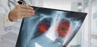 Doctor holding lung X ray with highlighted areas