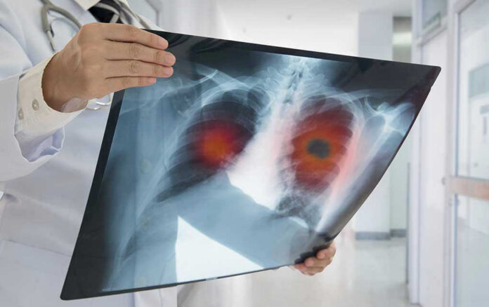 Doctor holding lung X ray with highlighted areas